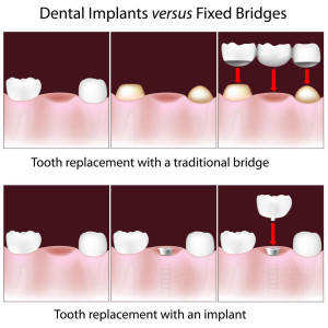 implant vs bridge shutterstock_113160364