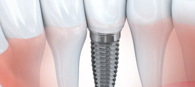 Dental implants | Pelago Dental